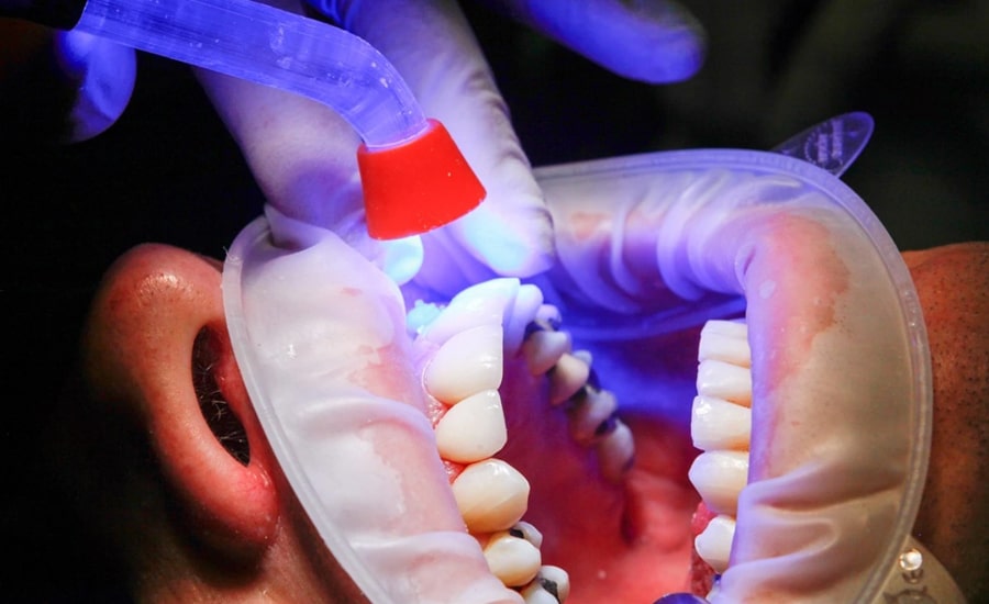 Dentistry Adhesives - Adhesive Products: Industrial UV Adhesives, Glues and Epoxies - Deepmaterial